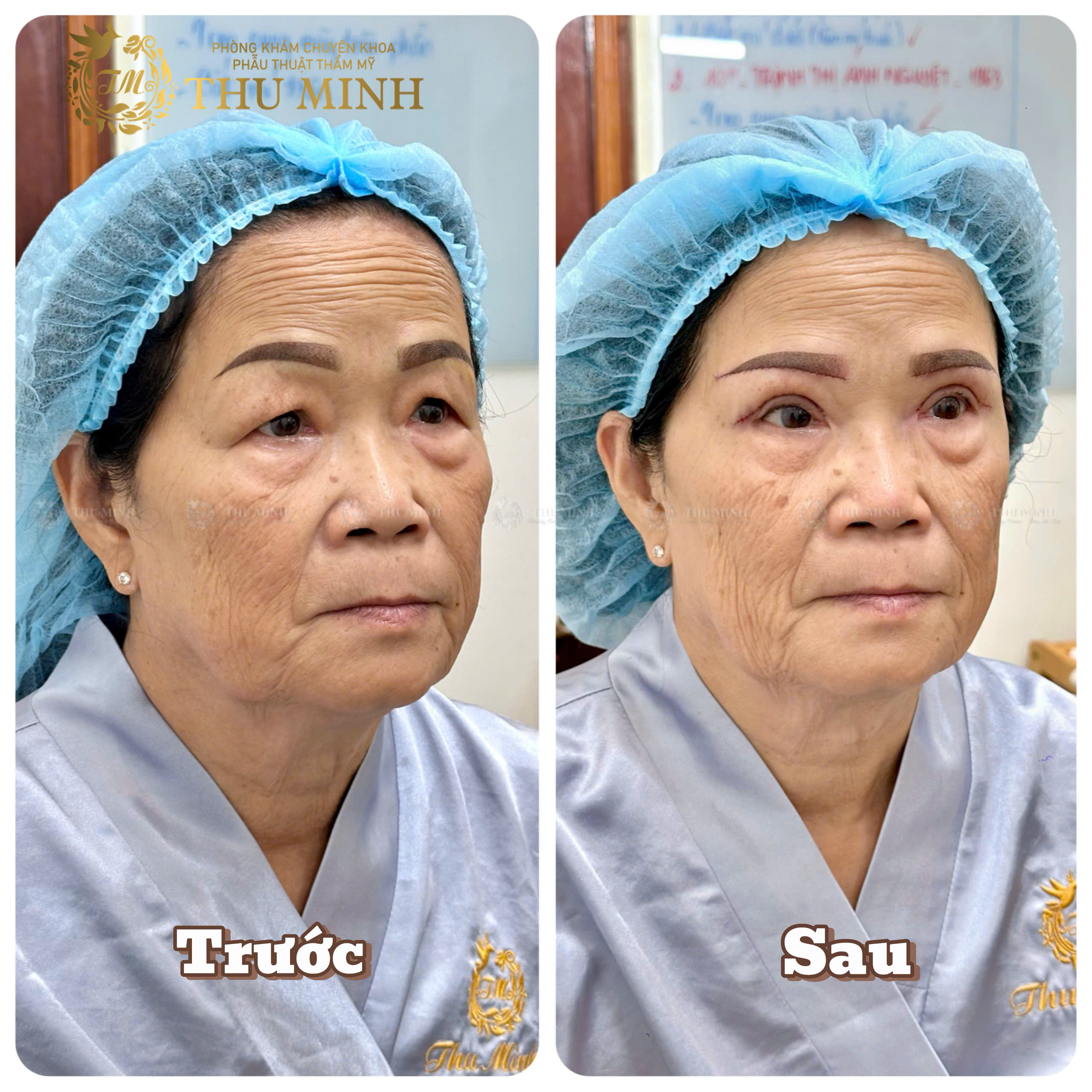 treo cung mày