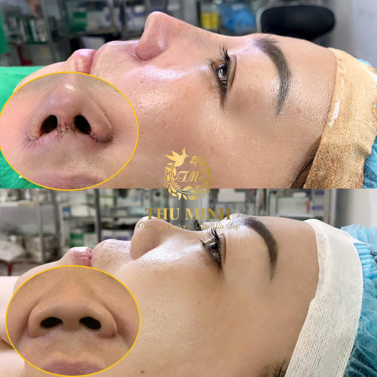 Cuốn Cánh Mũi Hàn Quốc