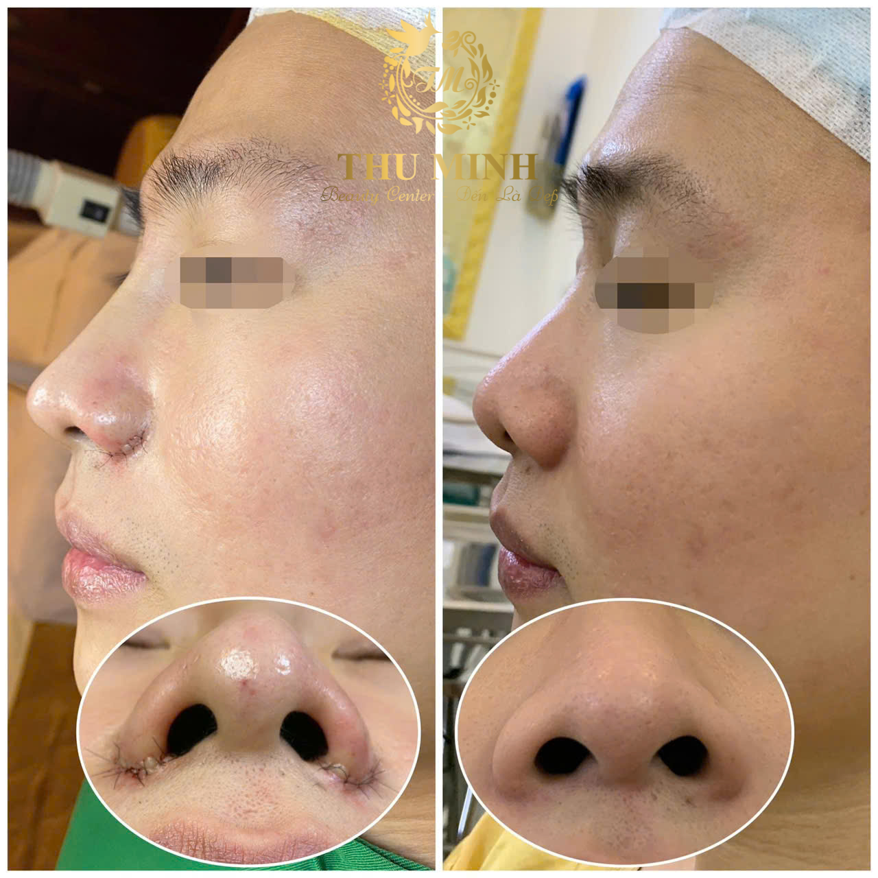 Cuốn Cánh Mũi Hàn Quốc