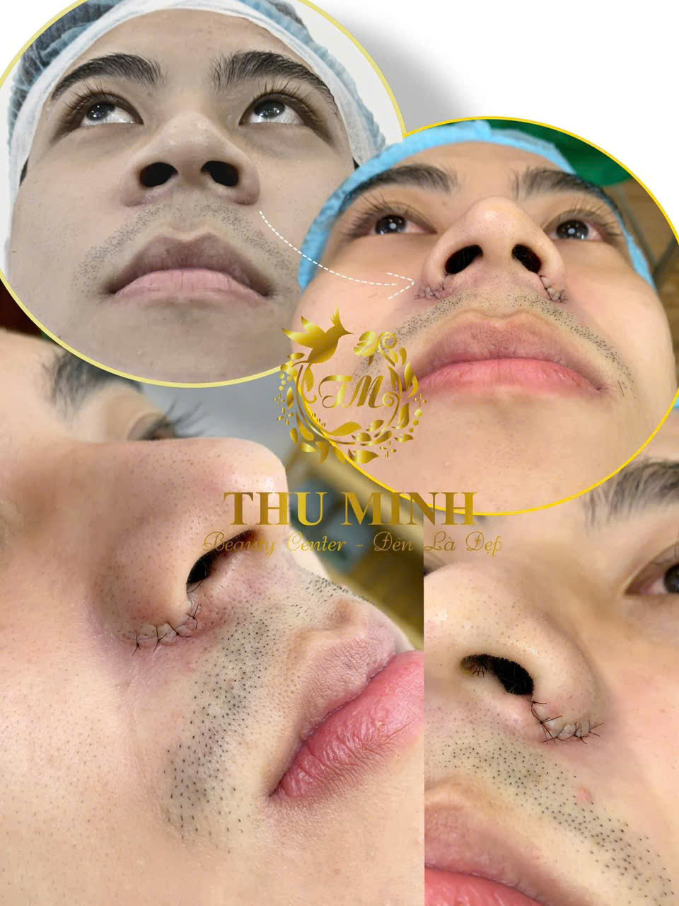 Cuốn Cánh Mũi Hàn Quốc