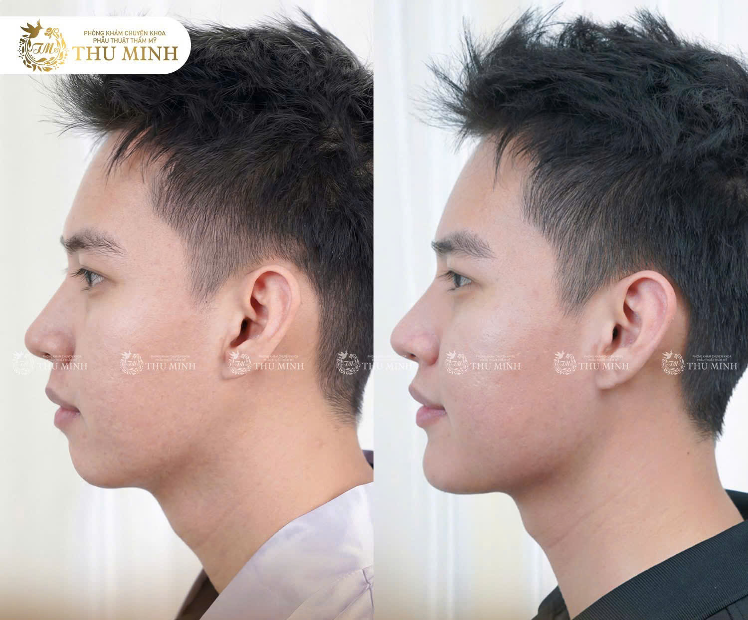 phẫu thuật cằm