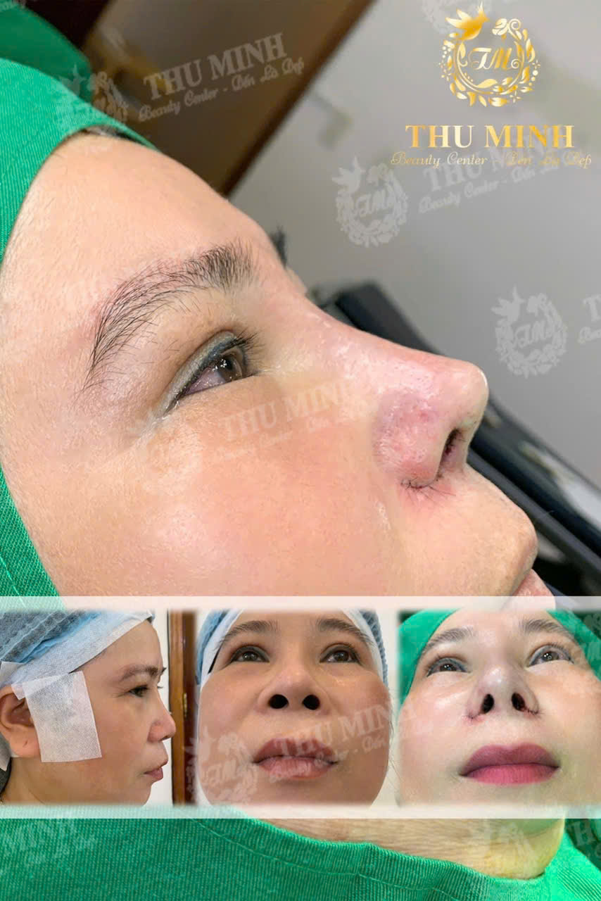 Cuốn Cánh Mũi Hàn Quốc