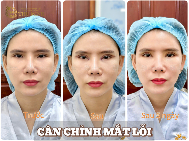 mắt 2 mí