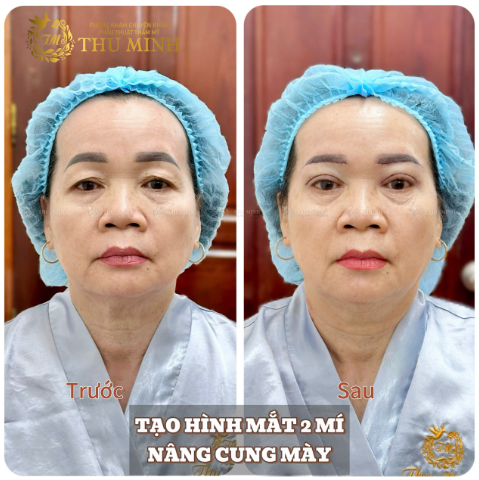 mắt 2 mí
