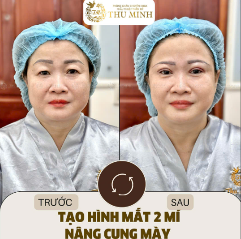 mắt 2 mí