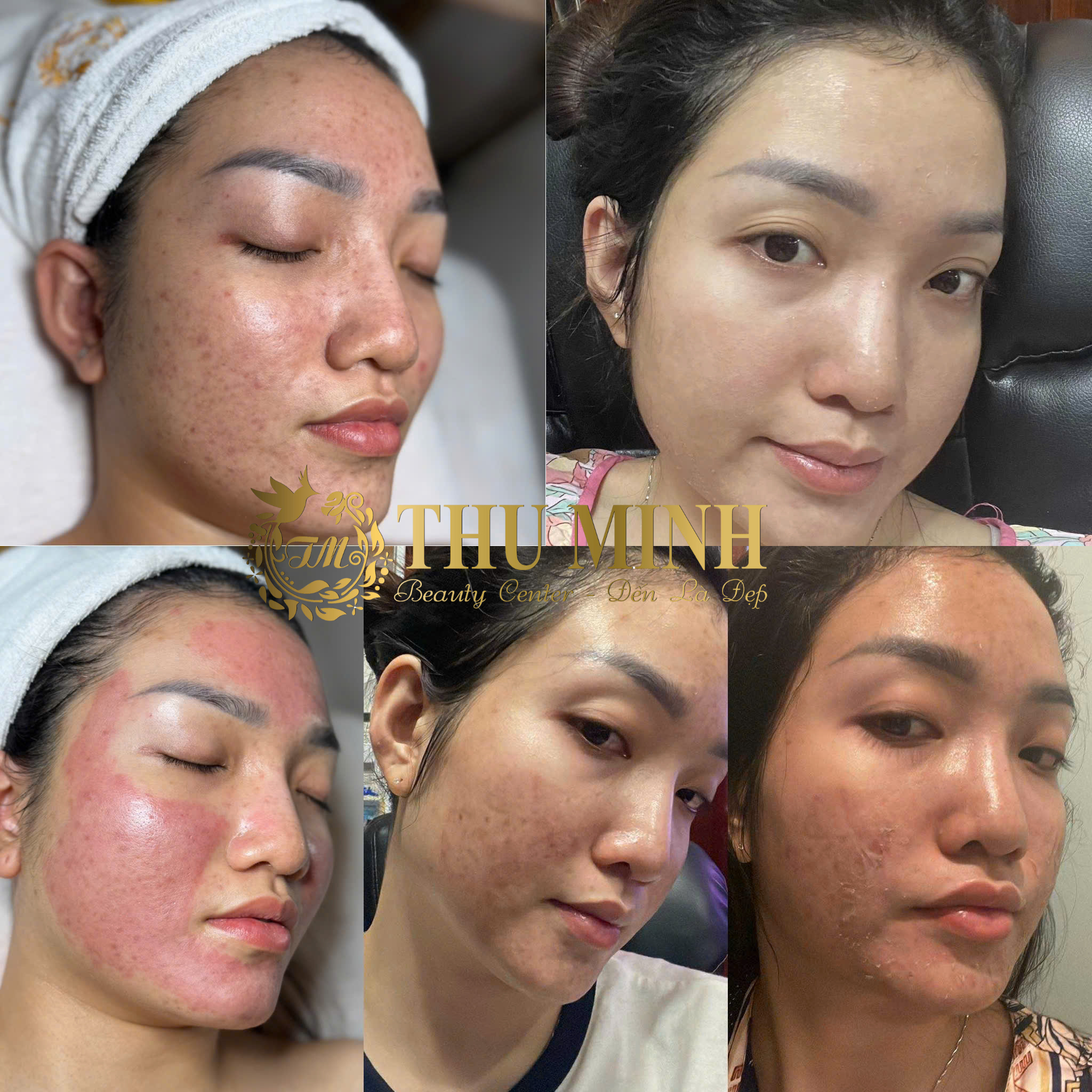 trẻ hoá da mặt