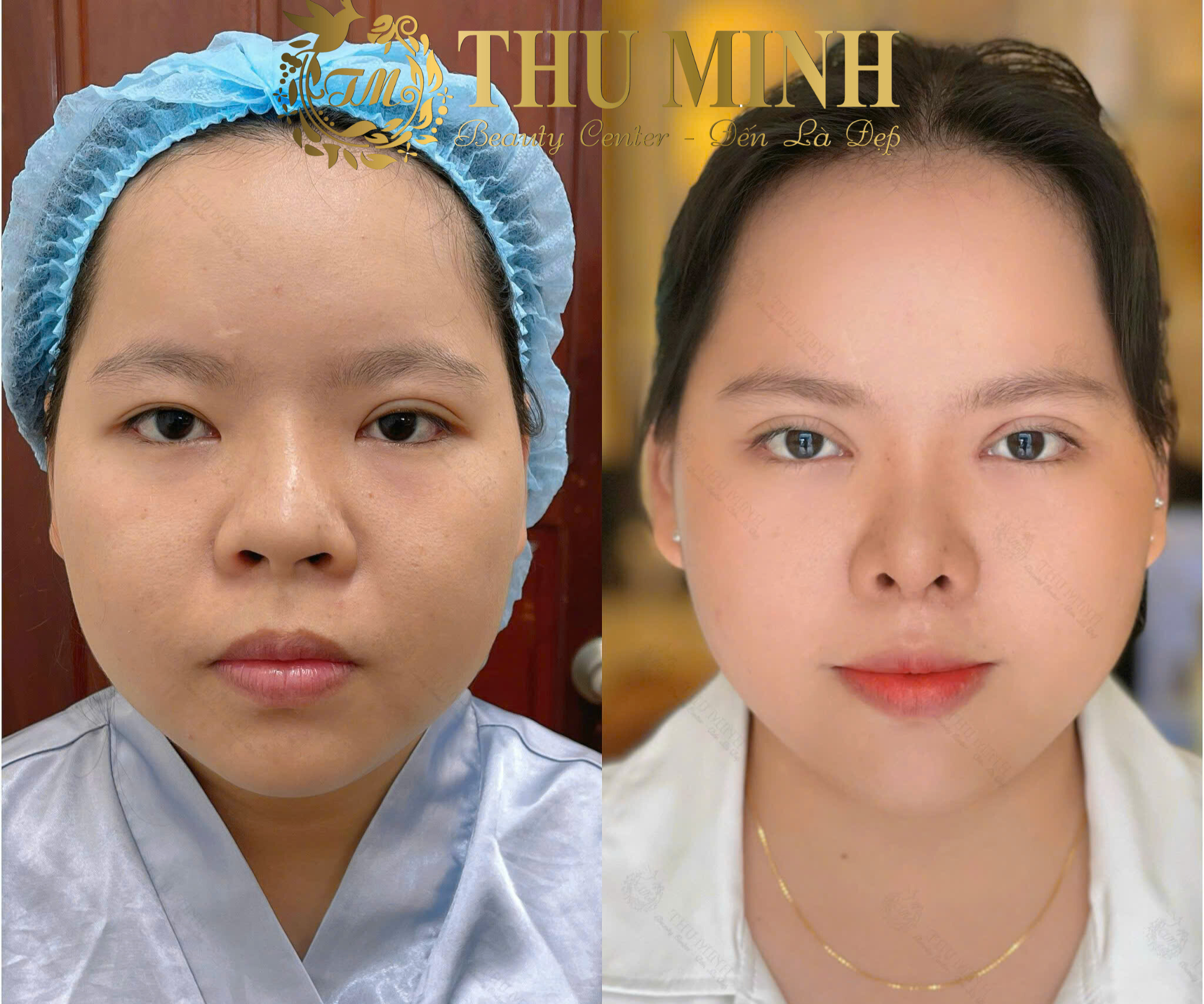 Nhấn Mí