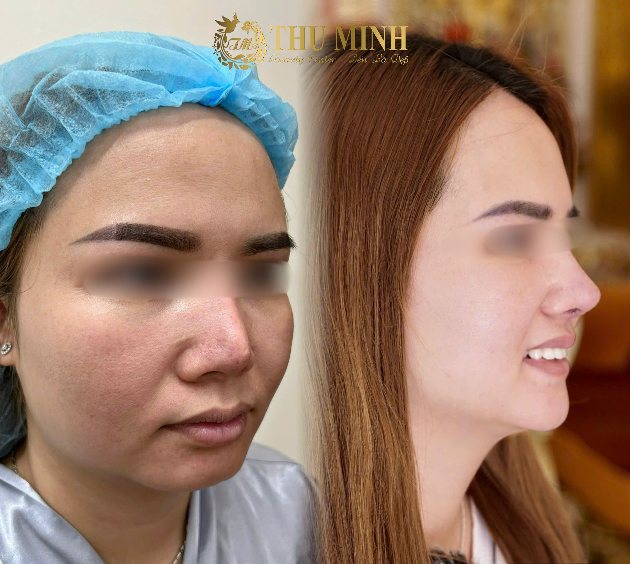phẫu thuật cằm