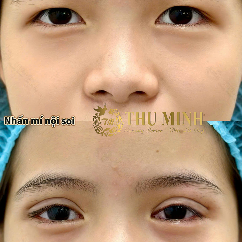 Nhấn mí