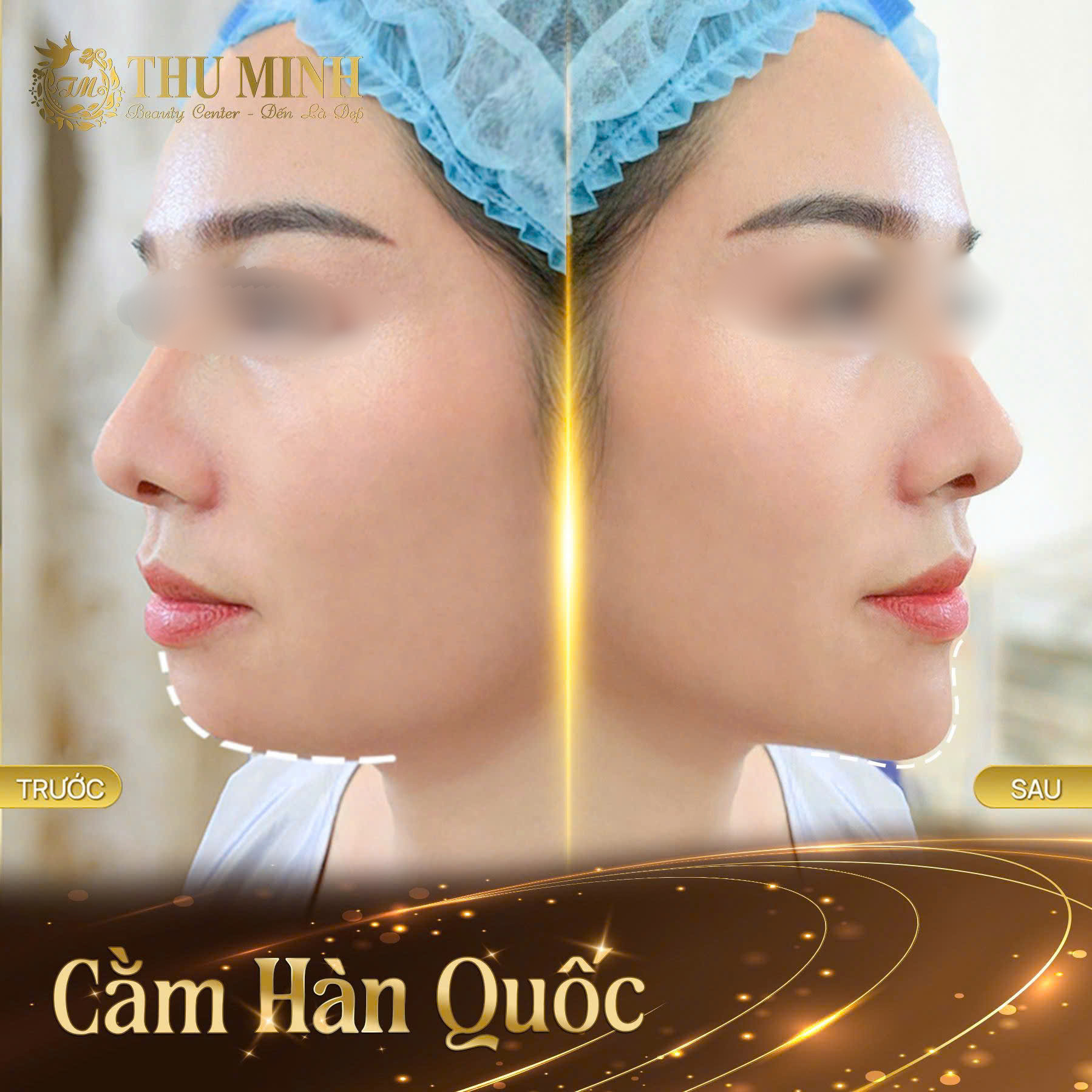 phẫu thuật cằm