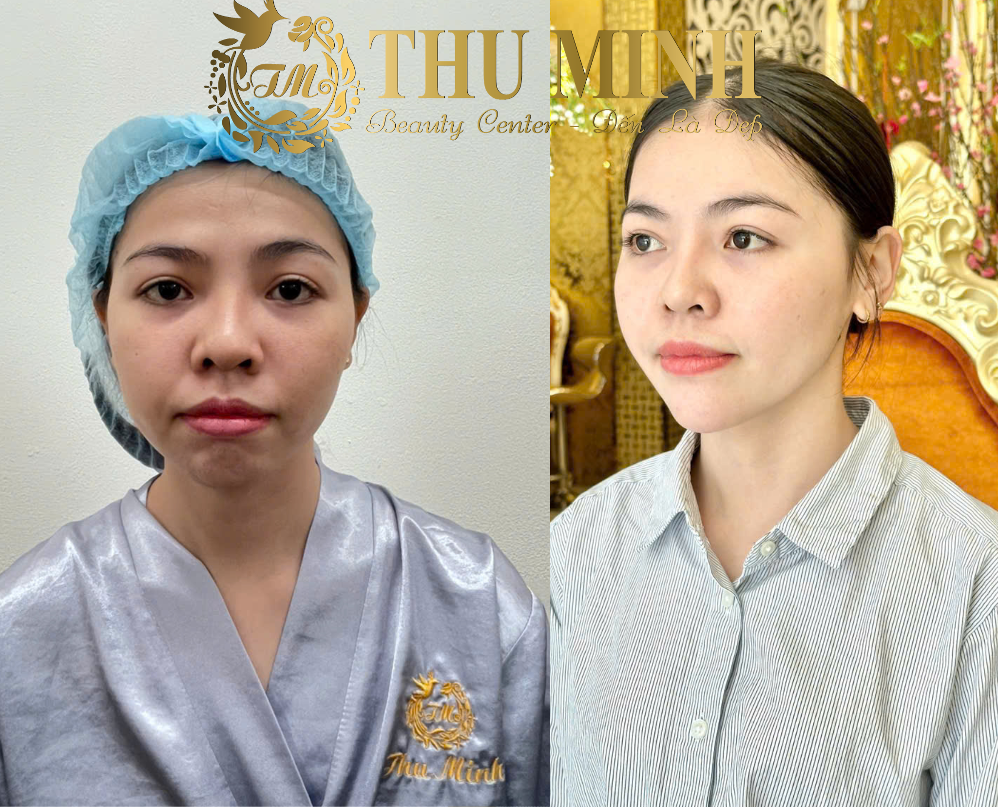 phẫu thuật cằm