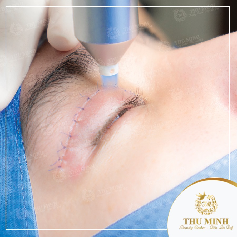 phục hồi sau phẫu thuật