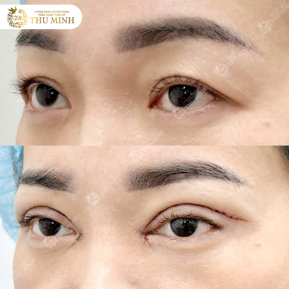 chăm sóc sau cắt mí mắt