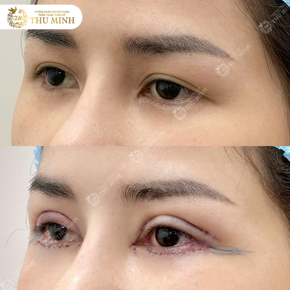 chăm sóc sau cắt mí mắt