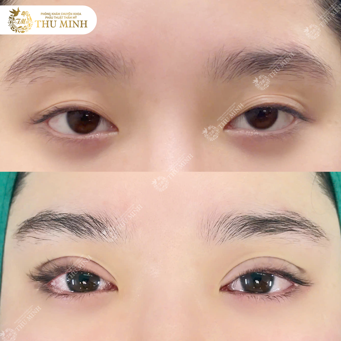 CHĂM SÓC SAU CẮT MÍ MẮT ĐÚNG CÁCH GIÚP NHANH LÀNH, LÊN FORM ĐẸP CHUẨN 2026