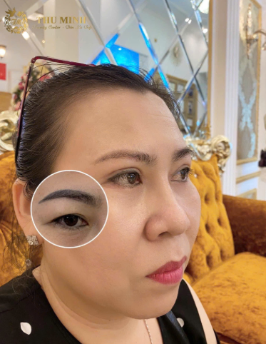 XOÁ XĂM LÔNG MÀY BẰNG LASER AN TOÀN – CHO 1 CẶP DÁNG MÀY TỰ NHIÊN HIỆN ĐẠI