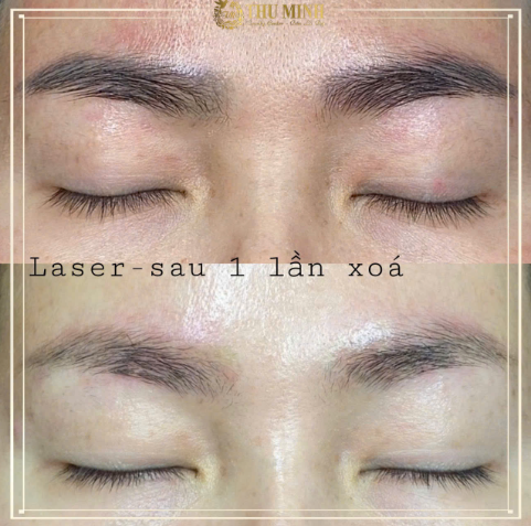 xoá xăm lông mày bằng laser