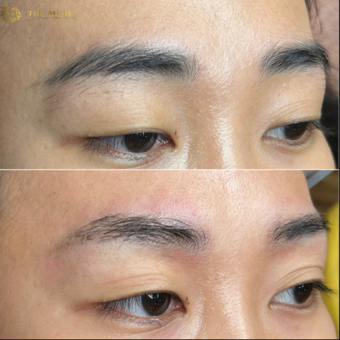 xoá xăm lông mày bằng laser