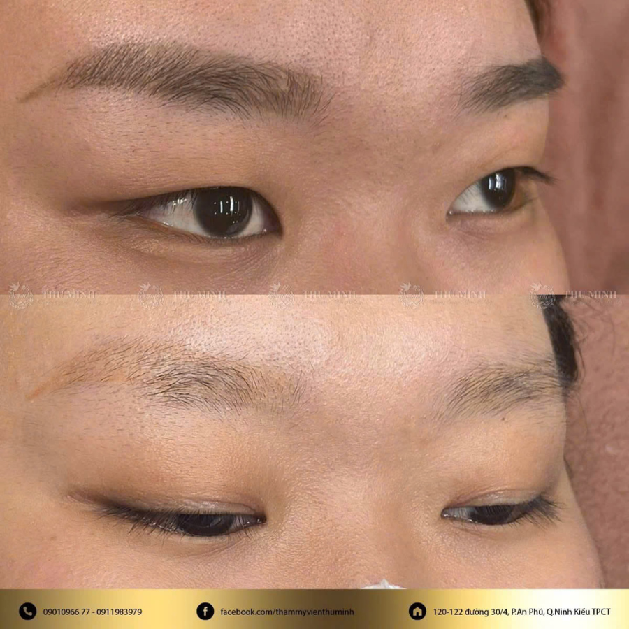 xoá xăm lông mày bằng laser