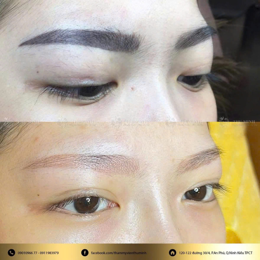 xoá xăm lông mày bằng laser
